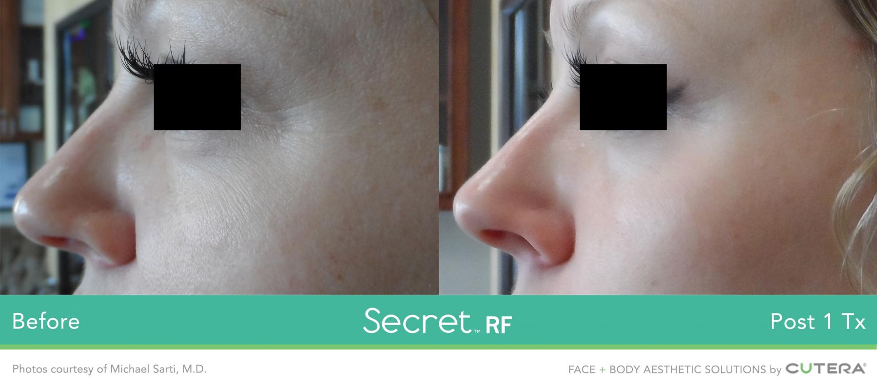 Secret RF: Patient 17 - Before and After 1