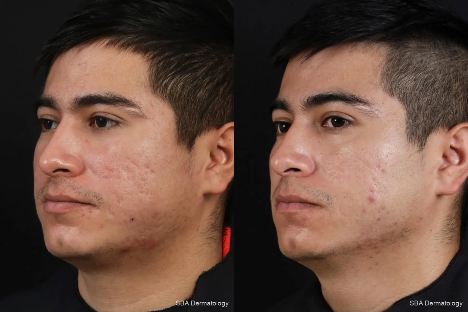 Secret RF: Patient 35 - Before and After 1