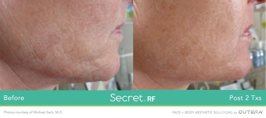 Secret RF Before & After Gallery: Patient 14