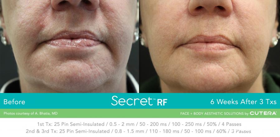 Secret RF Before & After Gallery: Patient 25