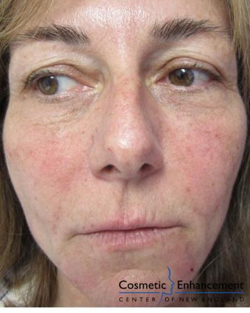 Vampire Facelift Before & After Gallery