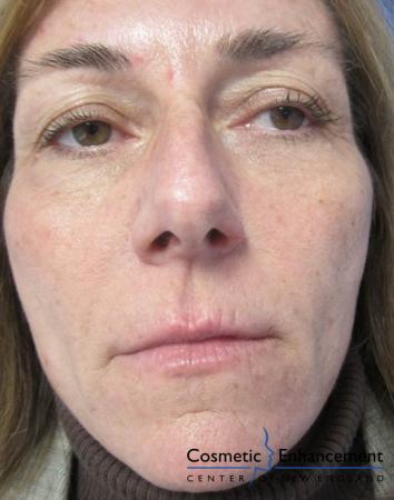 Vampire Facelift Before & After Gallery