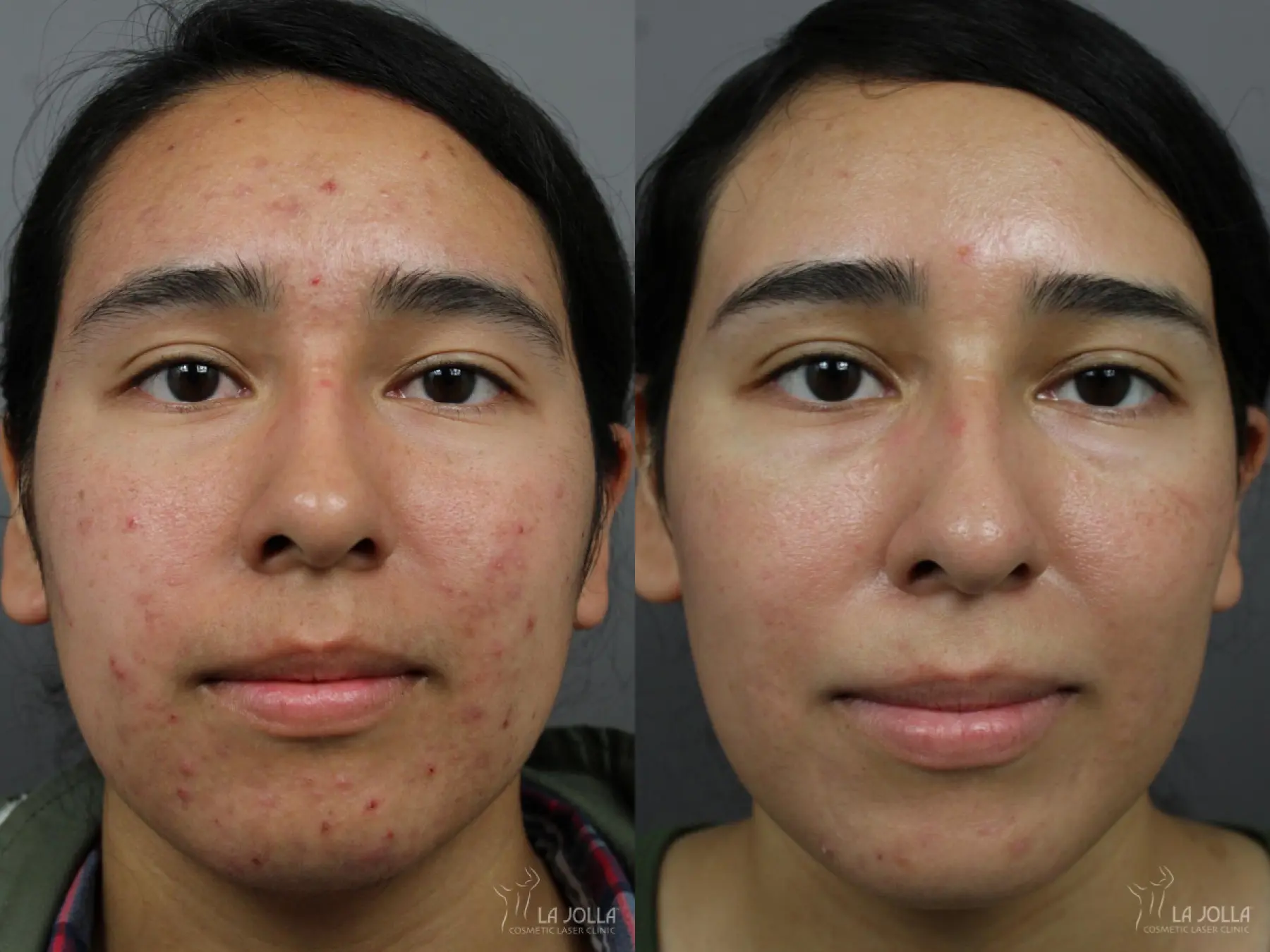 Acne Scars: Patient 8 - Before and After  