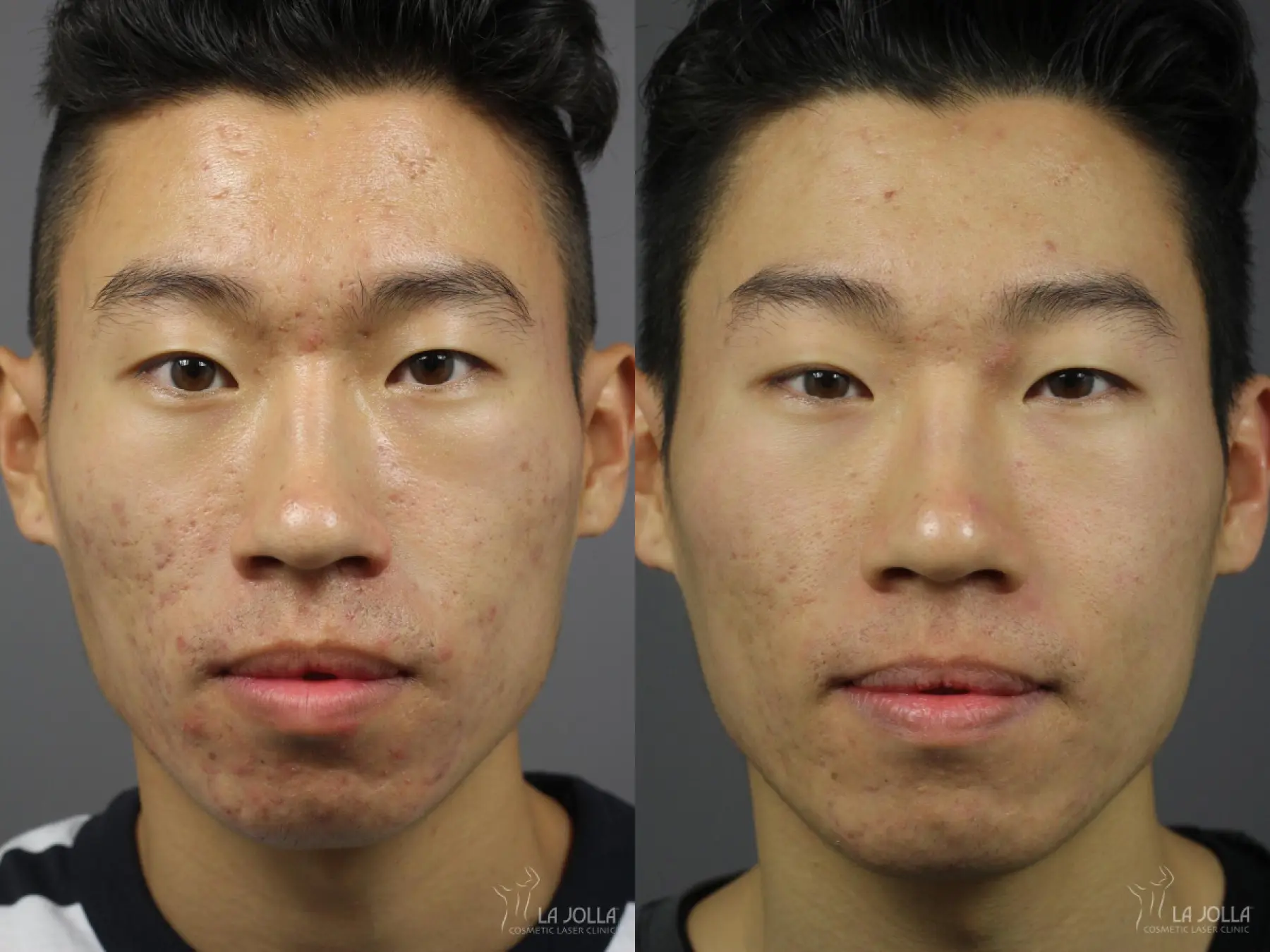 Acne Scars Before & After Gallery: Patient 2