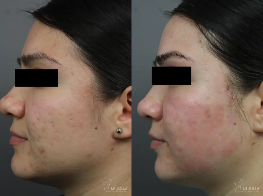 Acne Scars Before And After Gallery Patient 1