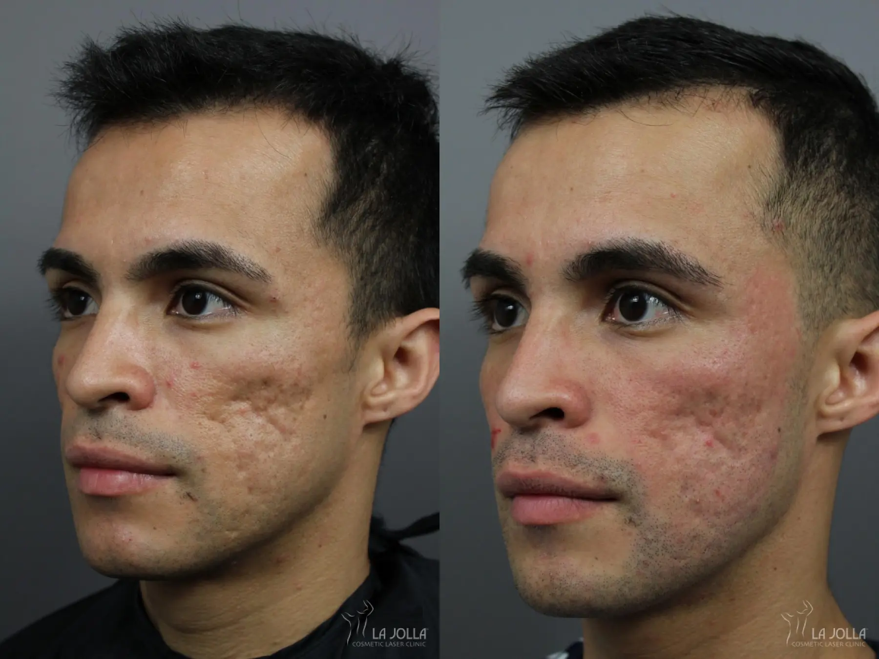 Acne Scars: Patient 7 - Before and After  