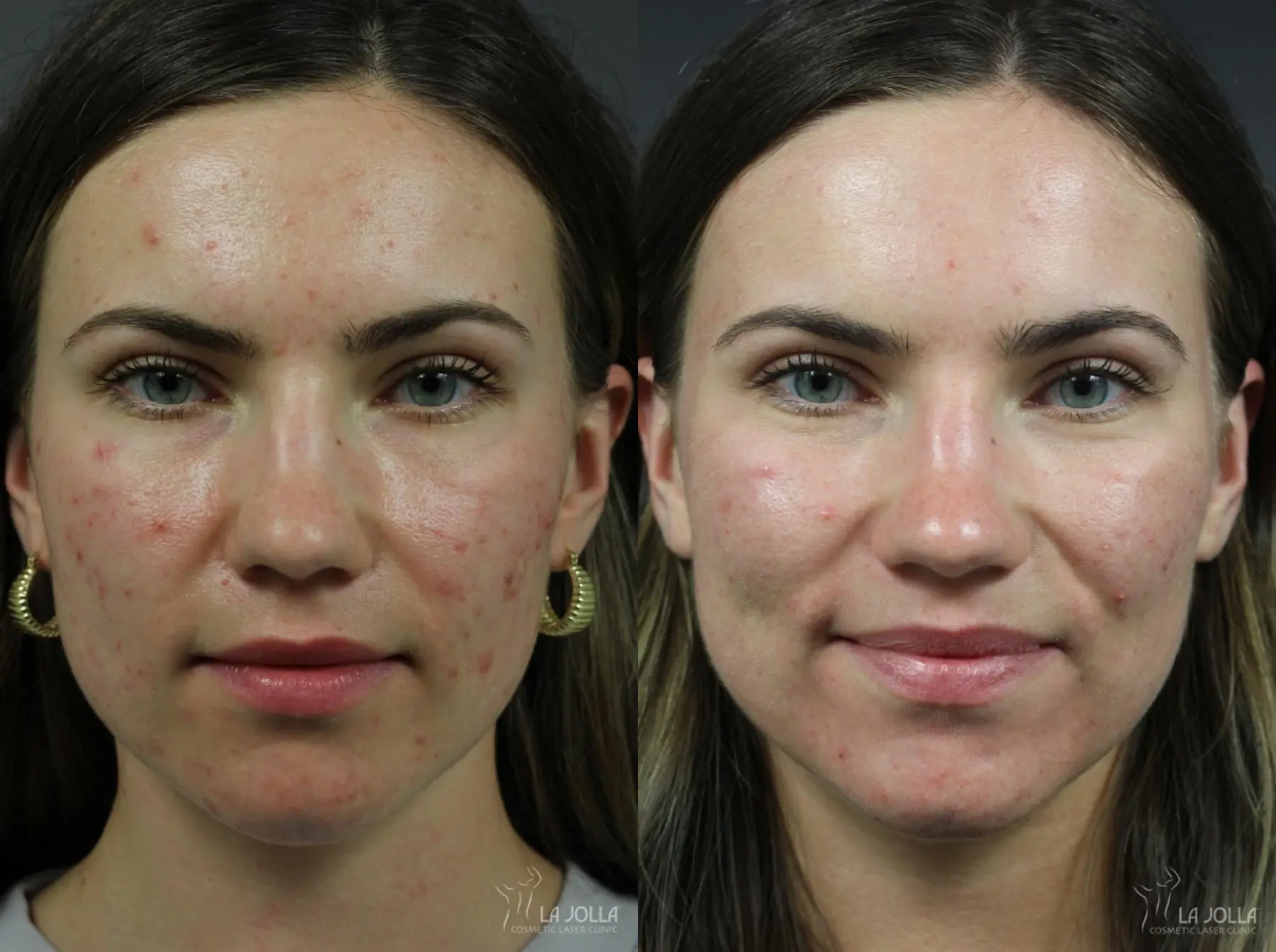 Acne Scars Before & After Gallery: Patient 11