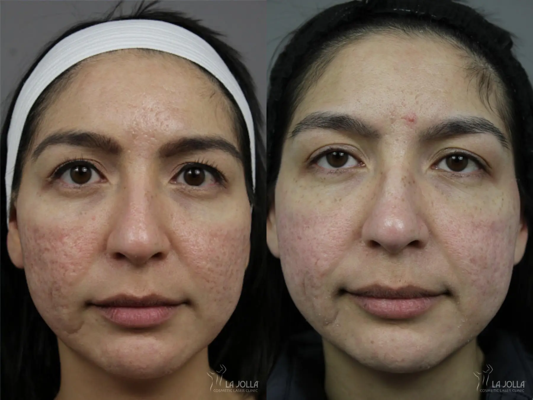 Acne Scars: Patient 1 - Before and After  