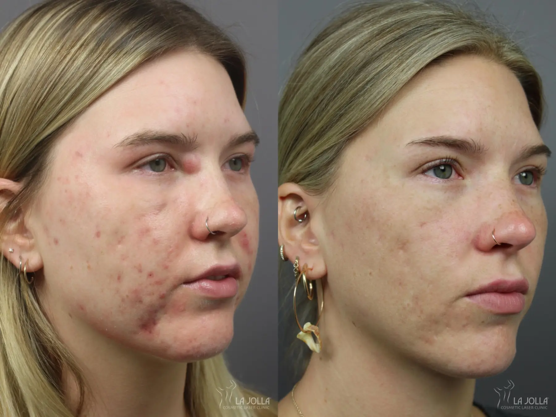 Acne Scars: Patient 6 - Before and After  