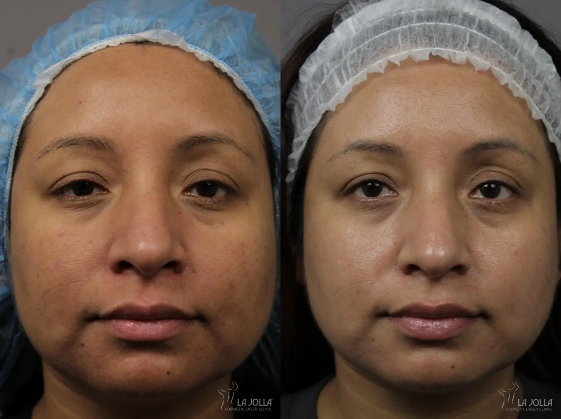 Chemical Peel Before & After Gallery: Patient 2