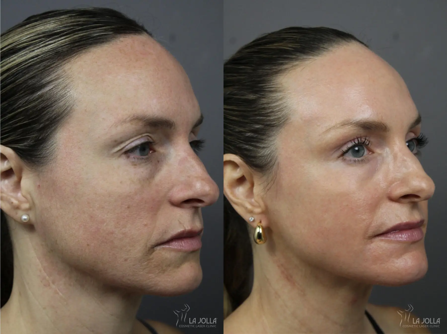 CO2 Laser: Patient 1 - Before and After 2