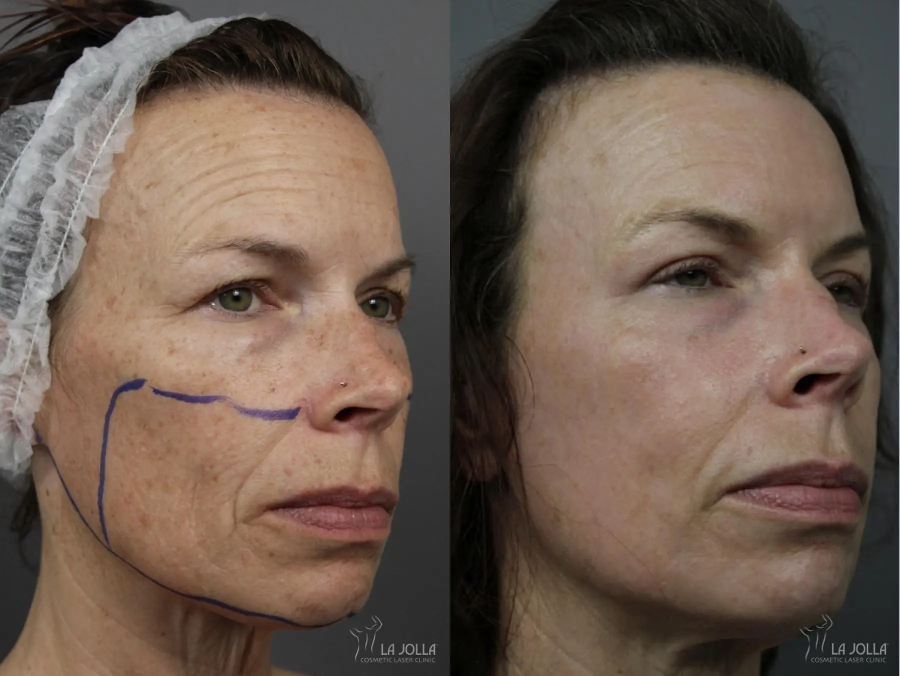 CO2 Laser: Patient 3 - Before and After 1