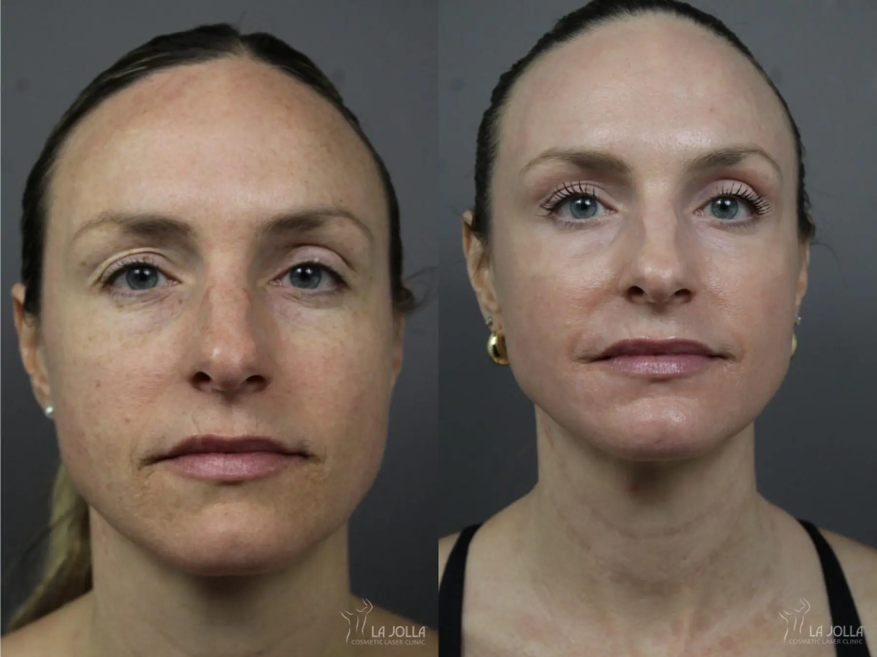 CO2 Laser: Patient 1 - Before and After 1