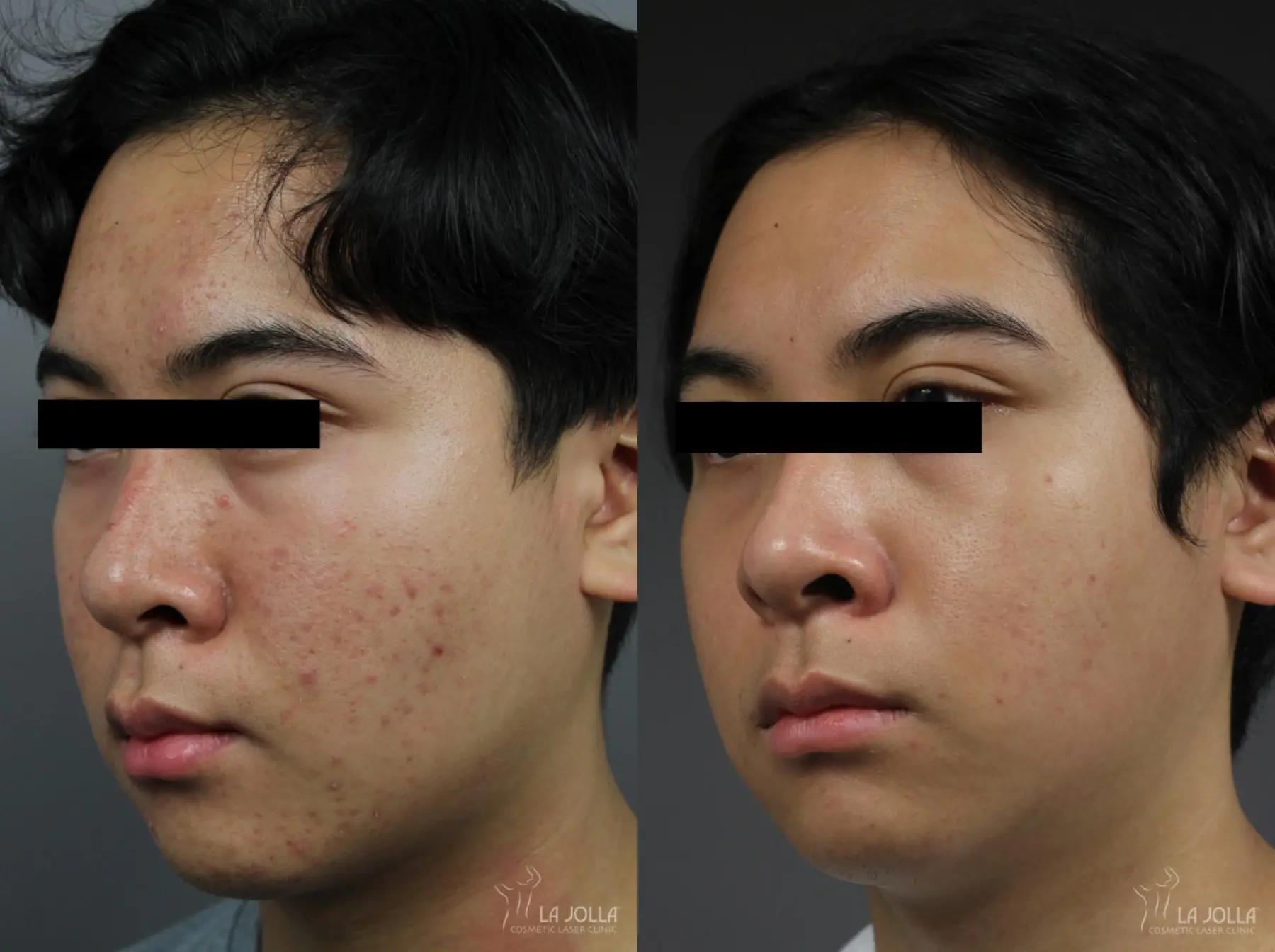 Fraxel®: Patient 11 - Before and After 2