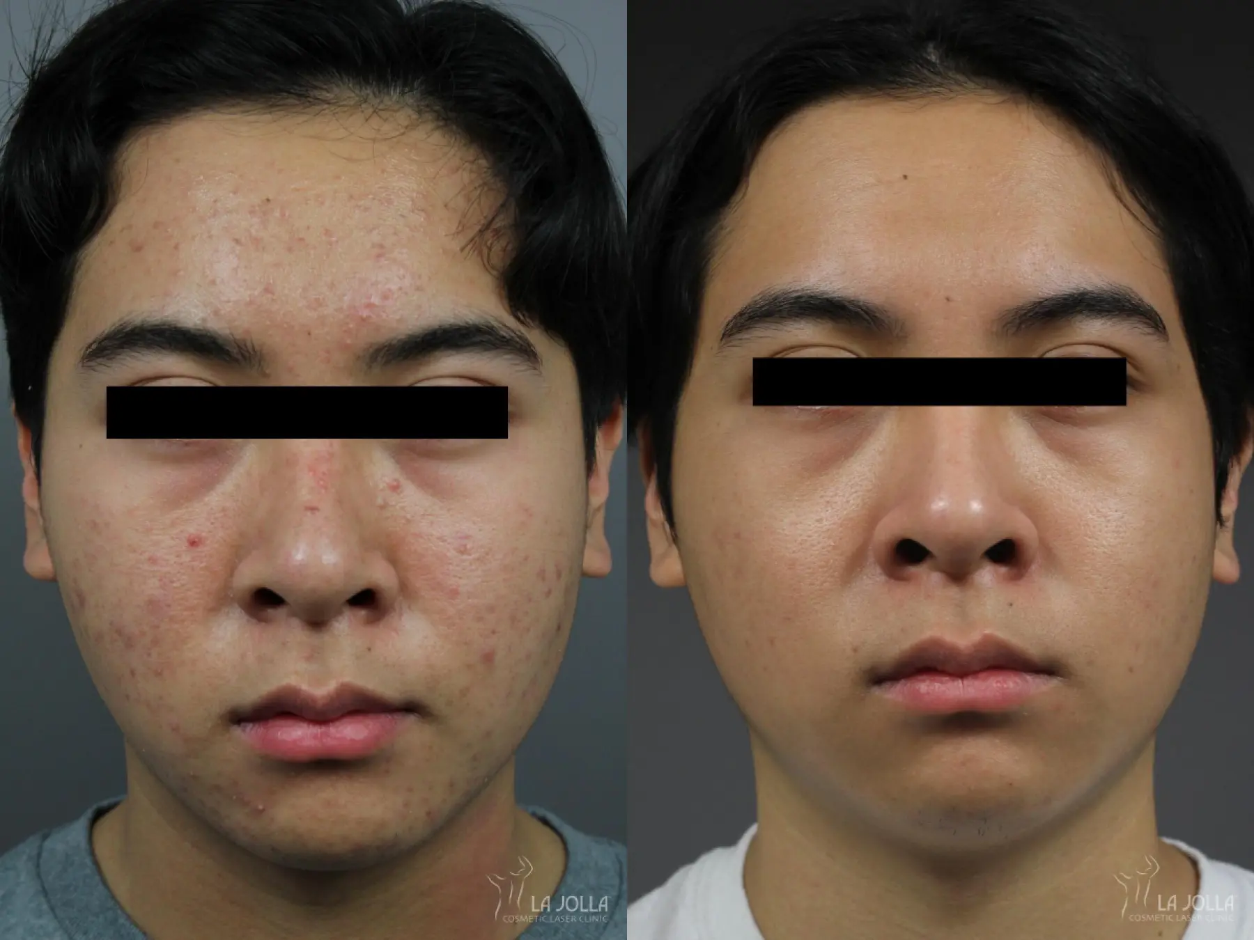 Fraxel®: Patient 11 - Before and After 1