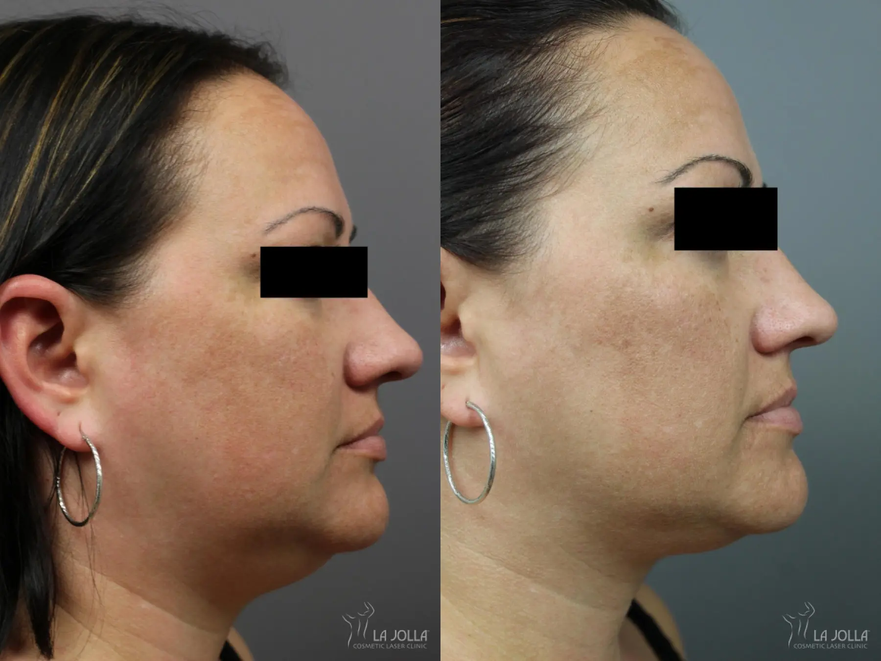 Kybella: Patient 7 - Before and After  