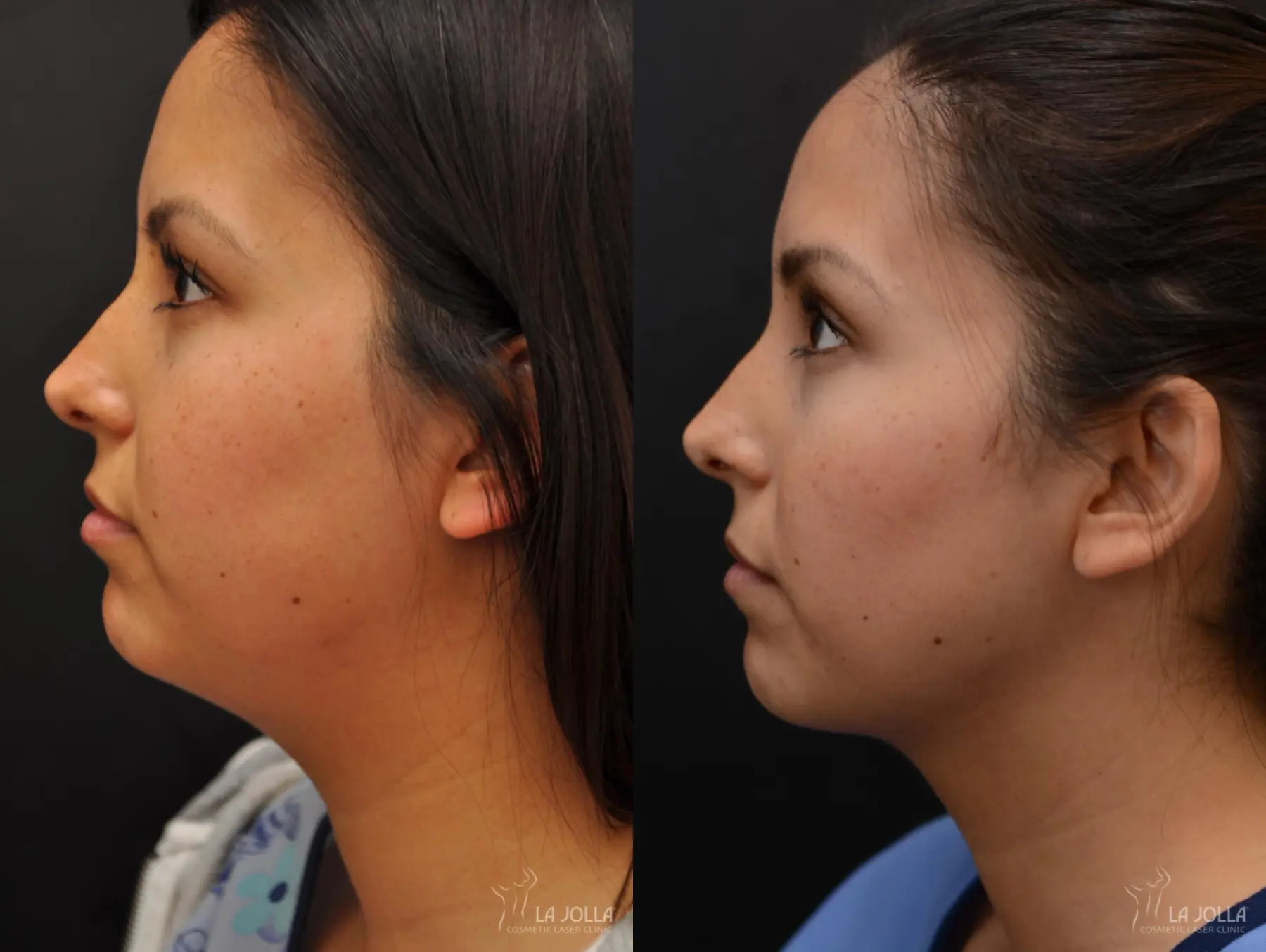 Kybella: Patient 4 - Before and After 1