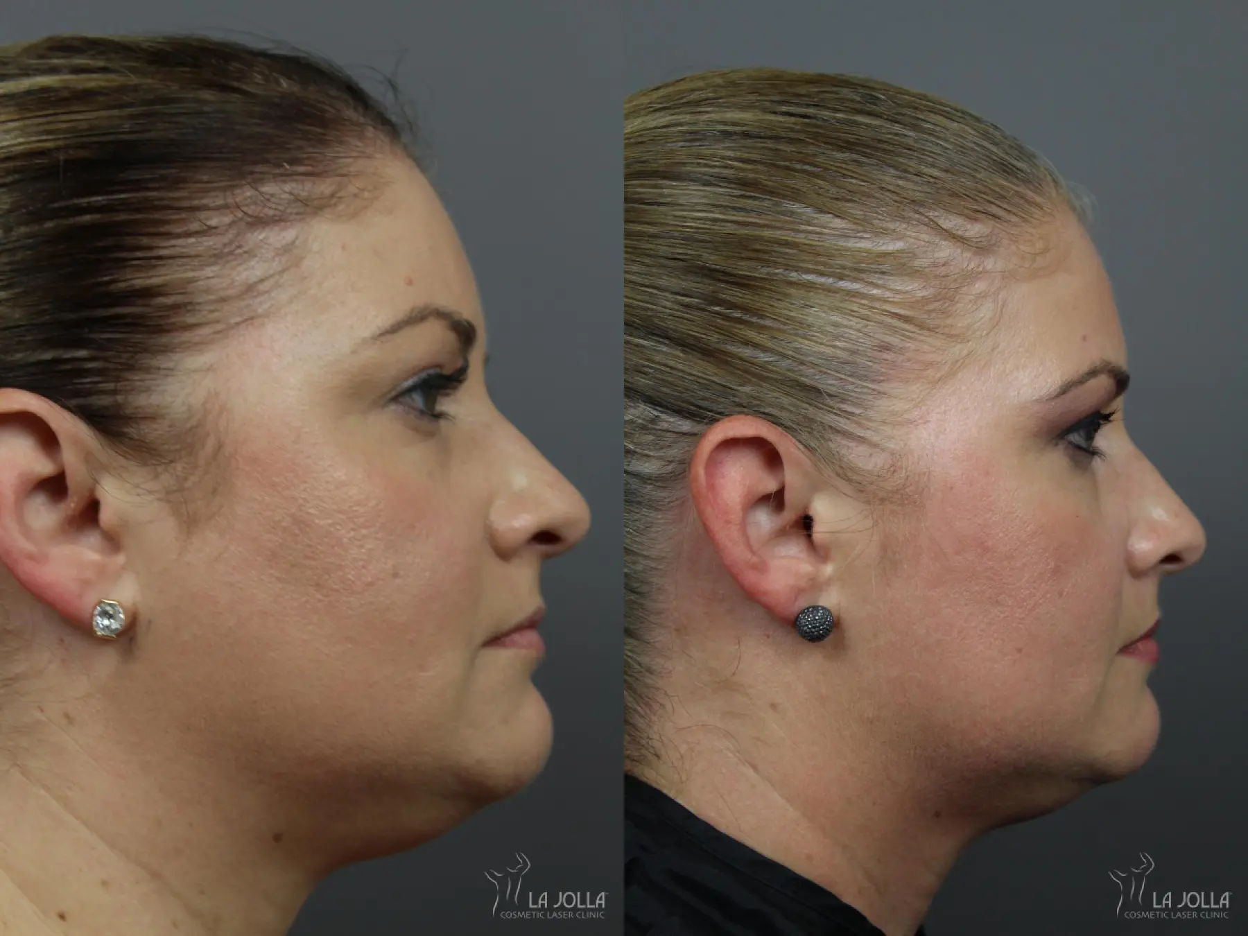 Kybella: Patient 2 - Before and After 1