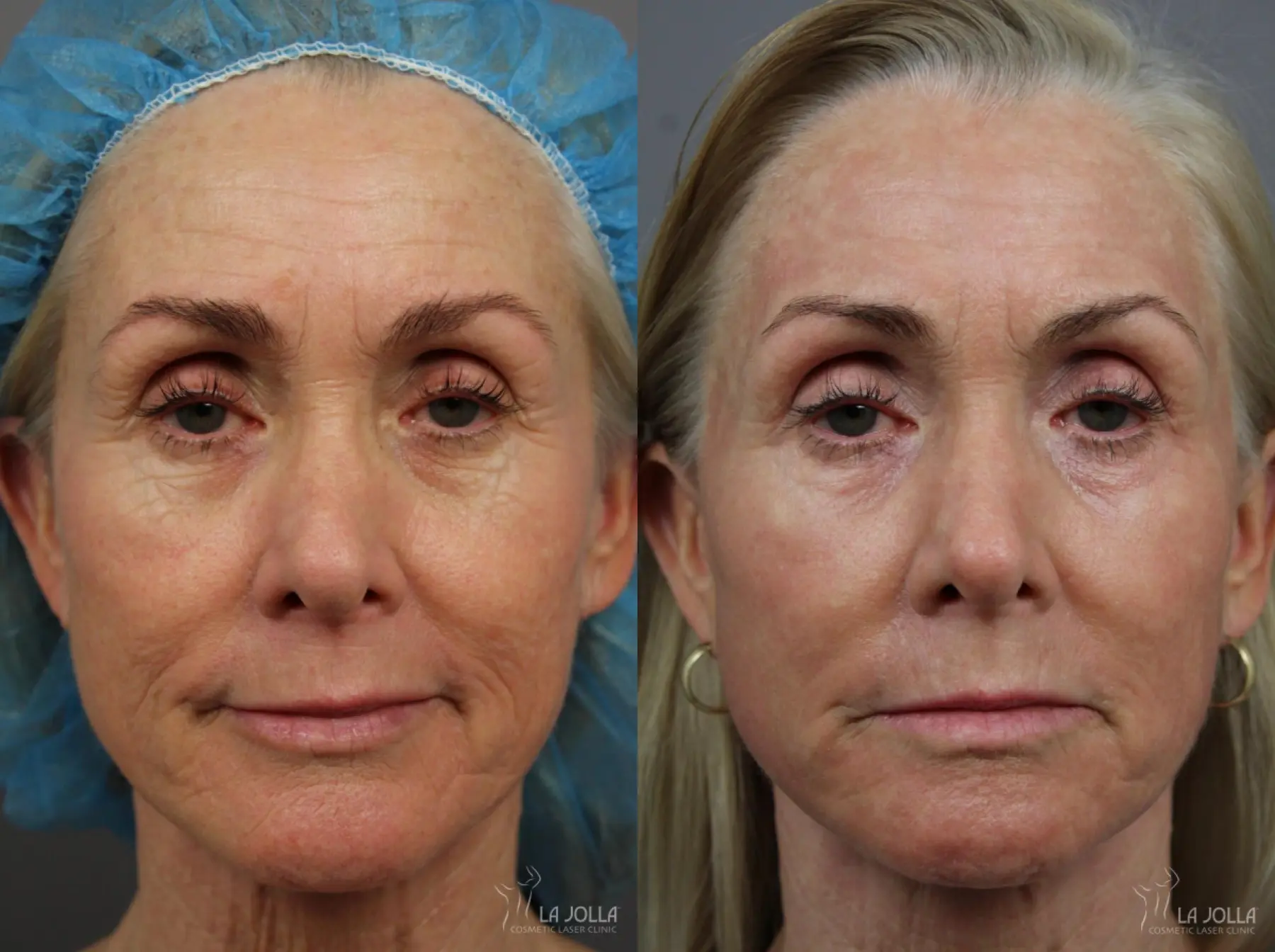 Laser Skin Resurfacing Patient 1 Before Procedure