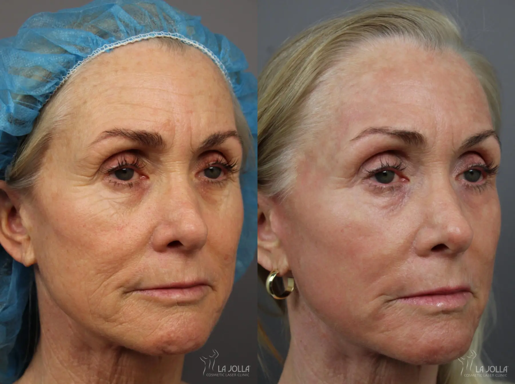 Laser Skin Resurfacing Patient 1 After Procedure