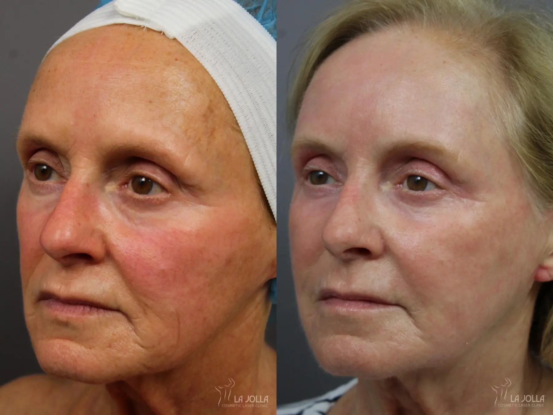 Laser Skin Resurfacing: Patient 2 - Before and After 1