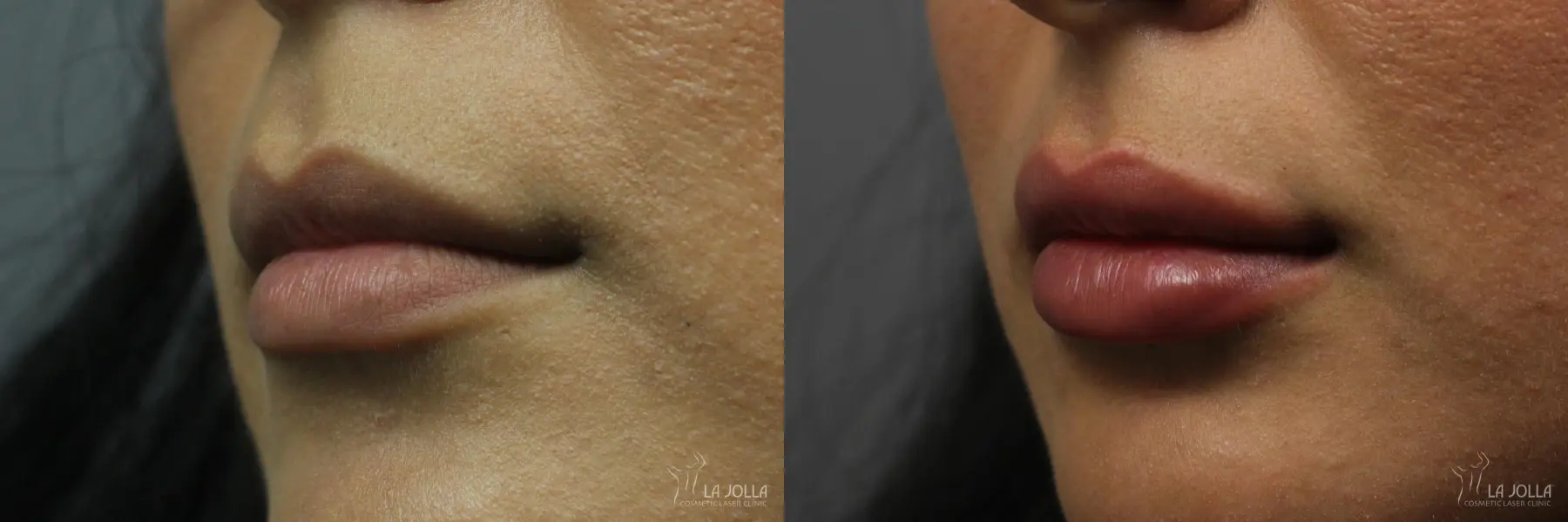 Lip Filler: Patient 1 - Before and After  