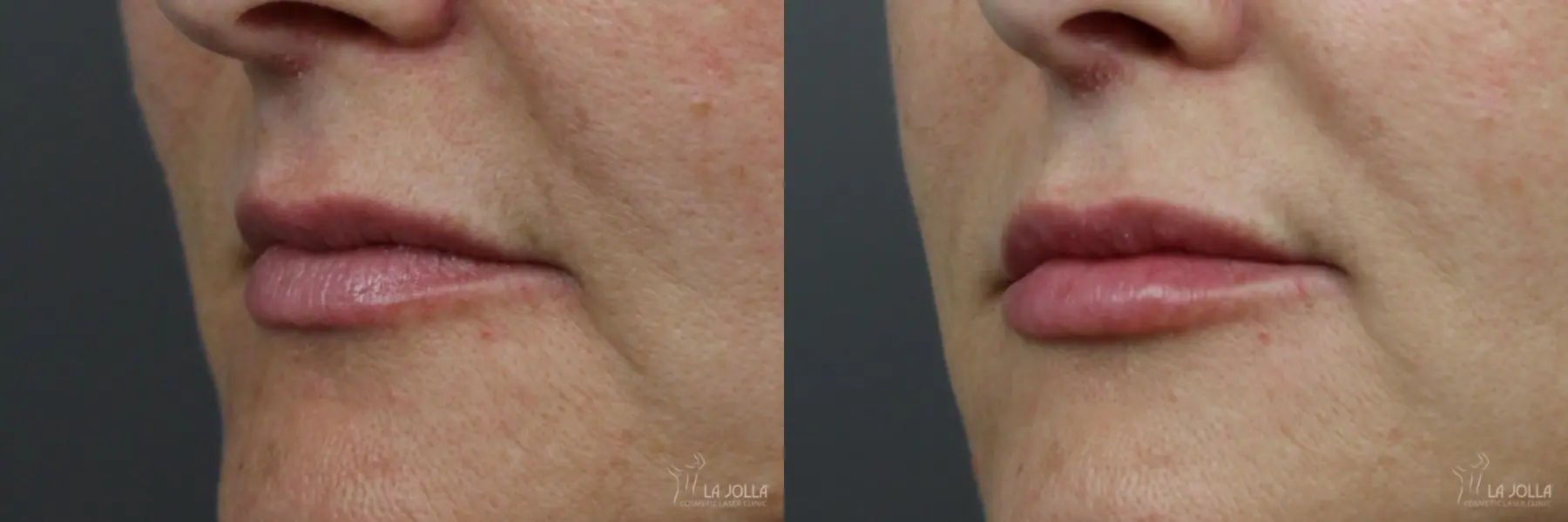 Lip Filler: Patient 3 - Before and After  