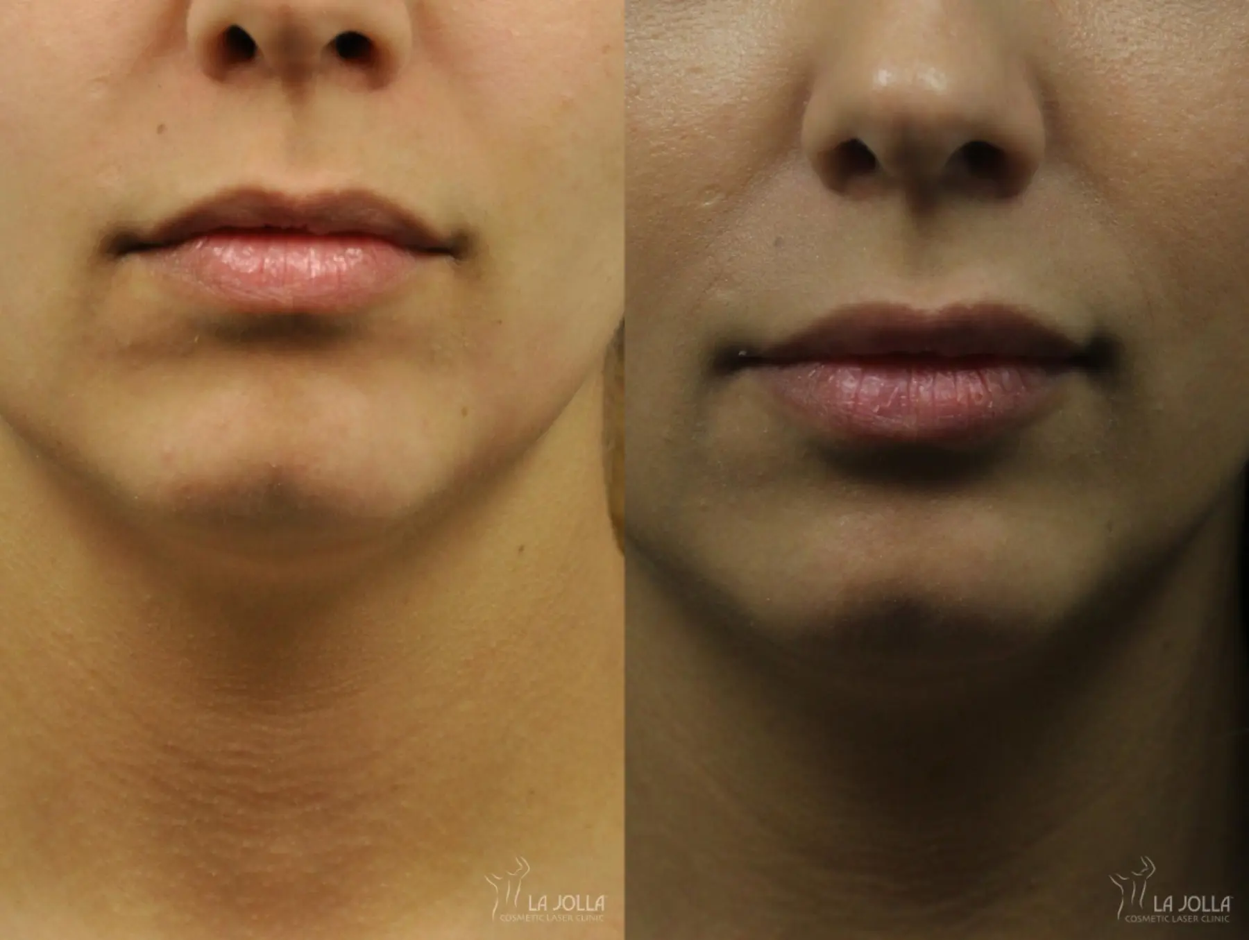 Lip Filler: Patient 9 - Before and After  