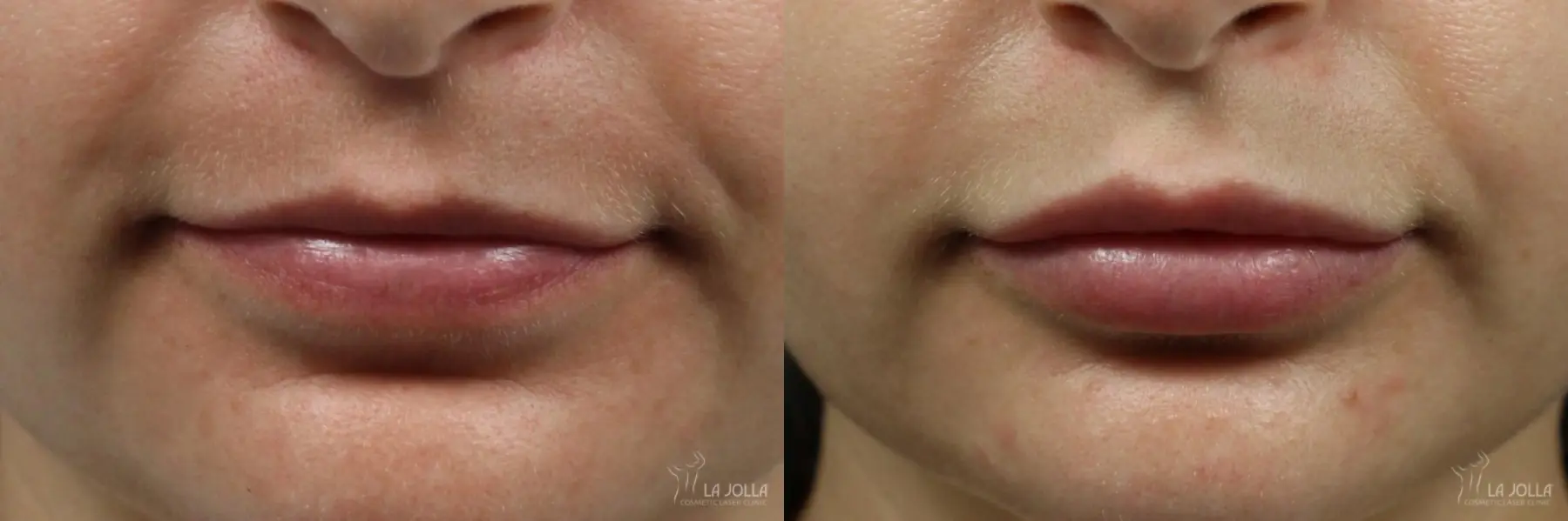 Lip Filler: Patient 7 - Before and After  