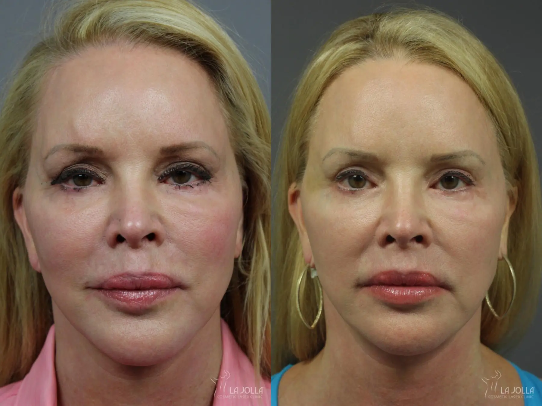 Liquid Facelift: Patient 4 - Before and After 1