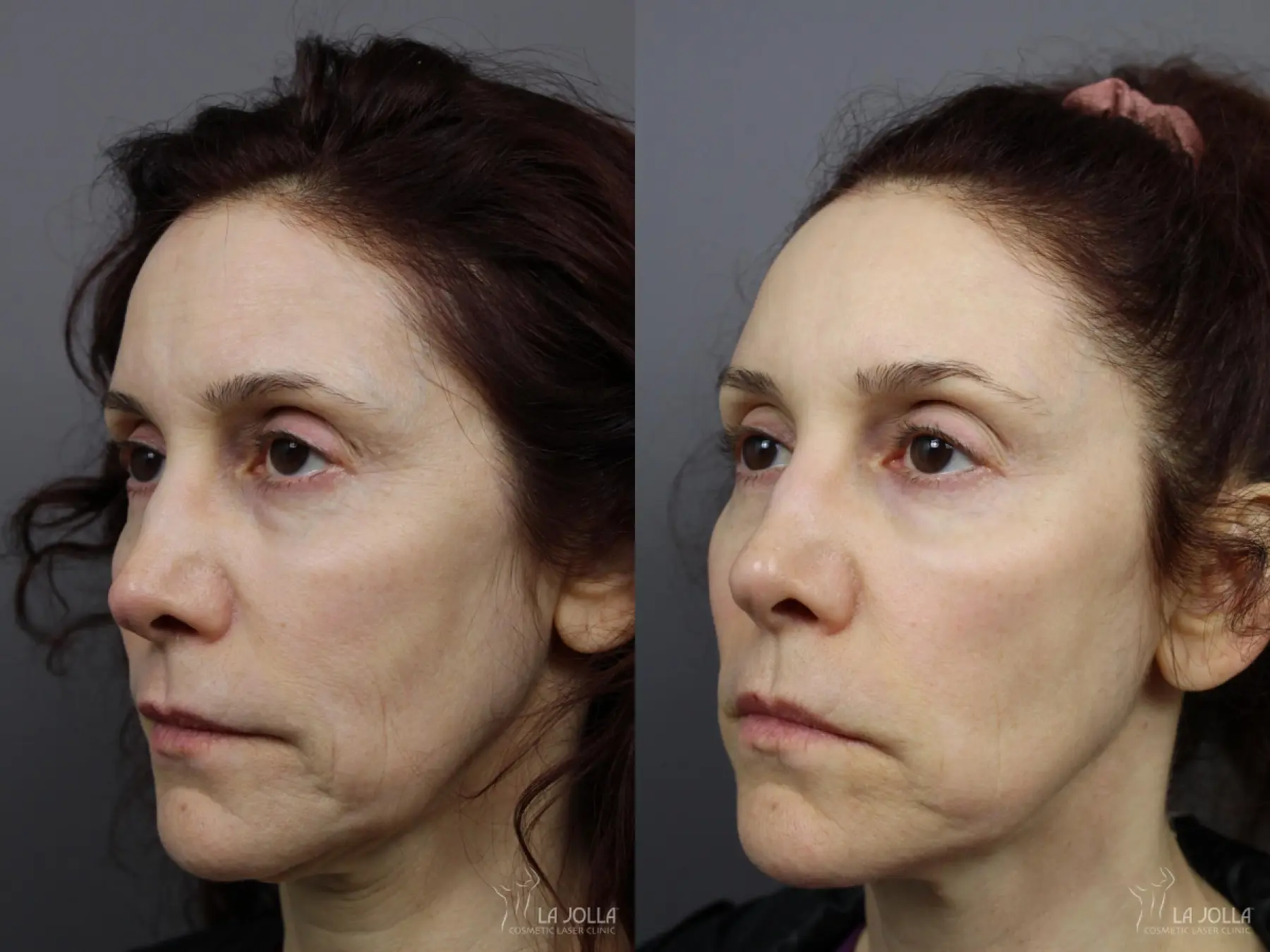 Liquid Facelift: Patient 2 - Before and After  