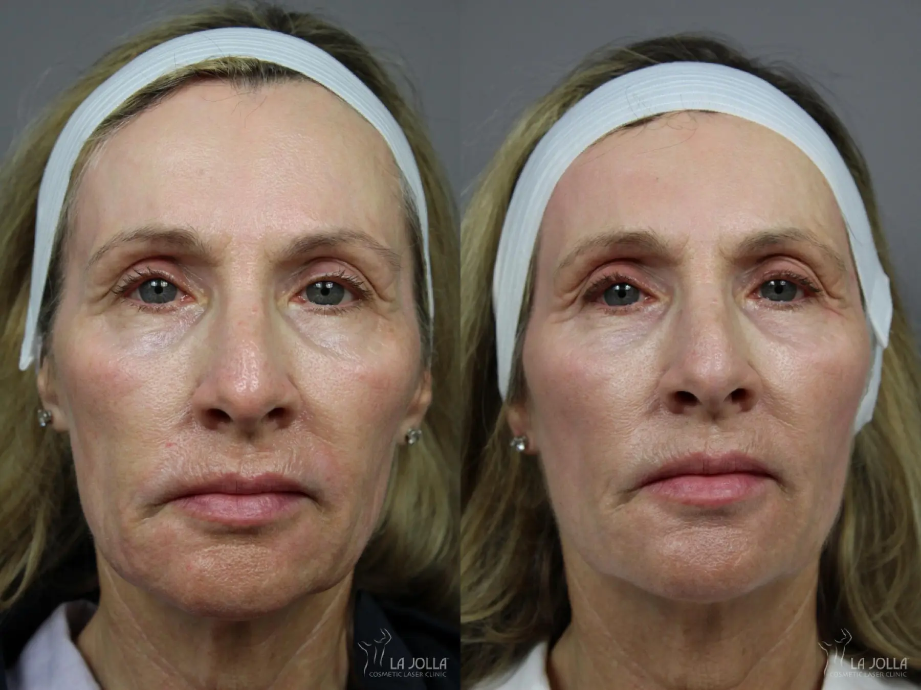 Liquid Facelift: Patient 3 - Before and After 1