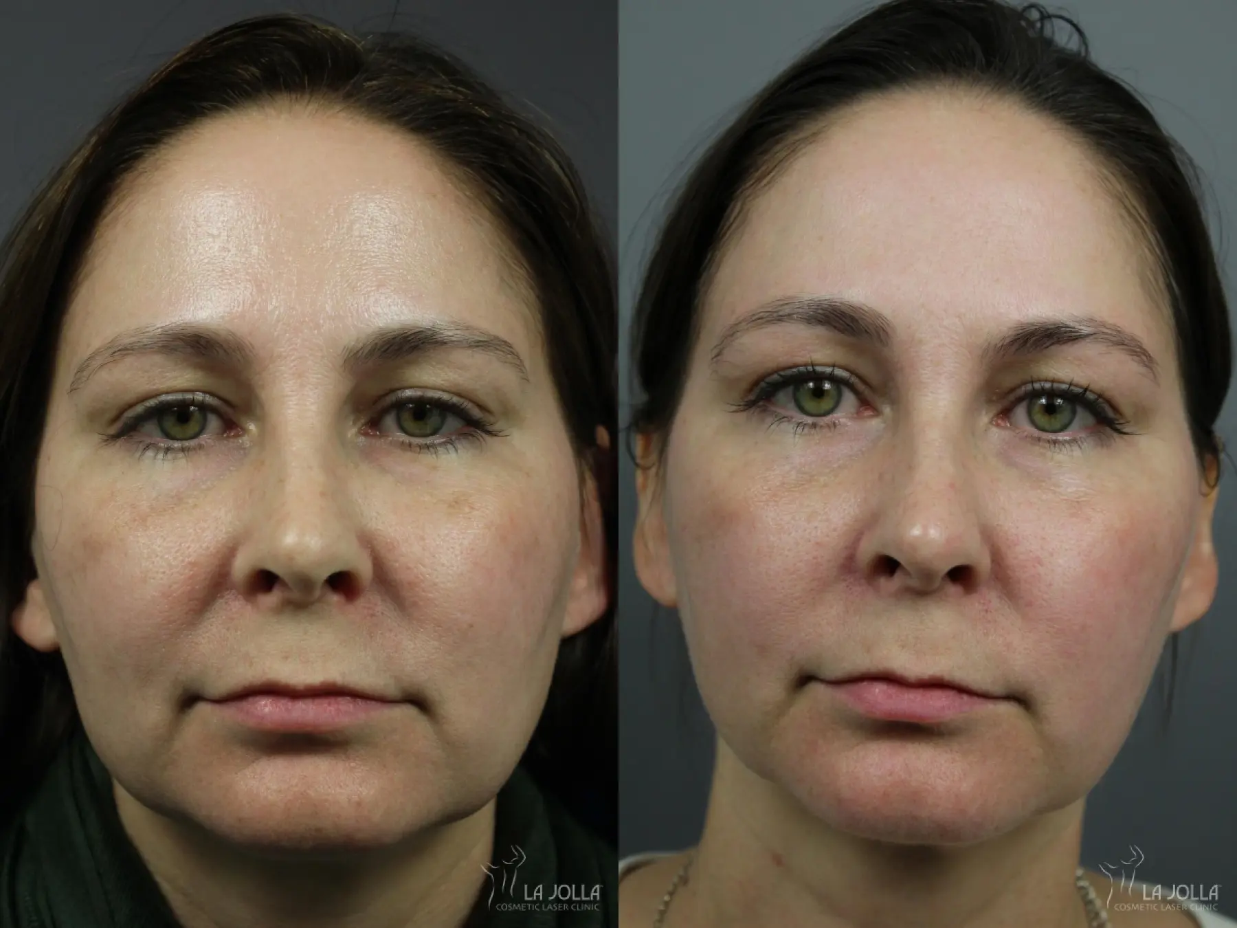 Liquid Facelift: Patient 1 - Before and After  