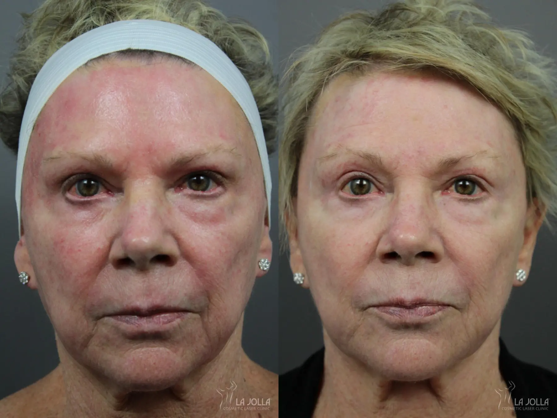 Liquid Facelift: Patient 6 - Before and After  
