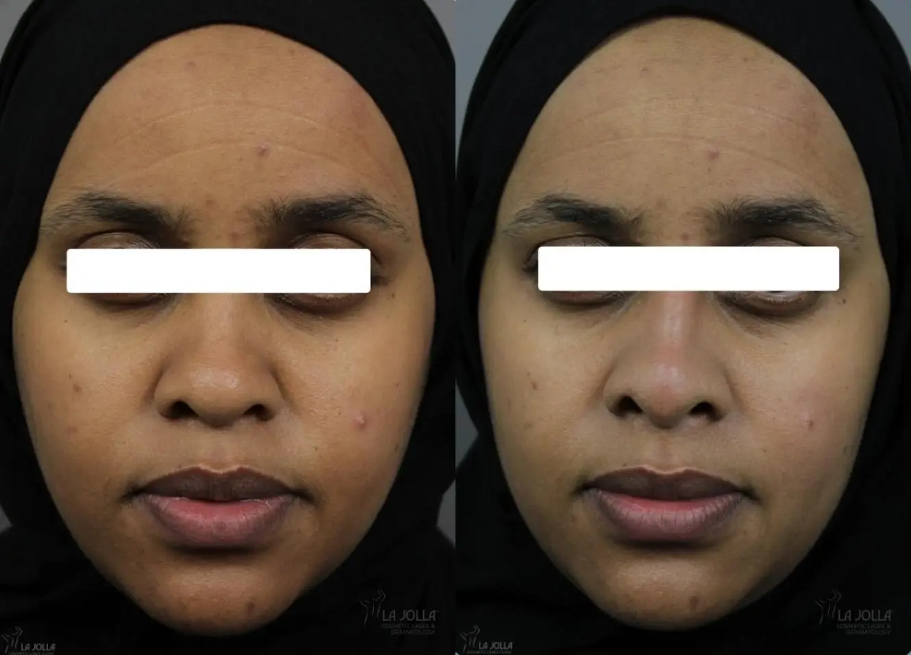 Nose Filler: Patient 9 - Before and After  