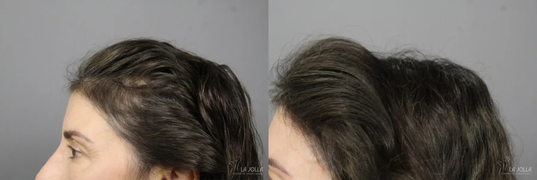 PRP (Platelet-Rich Plasma): Patient 1 - Before and After  