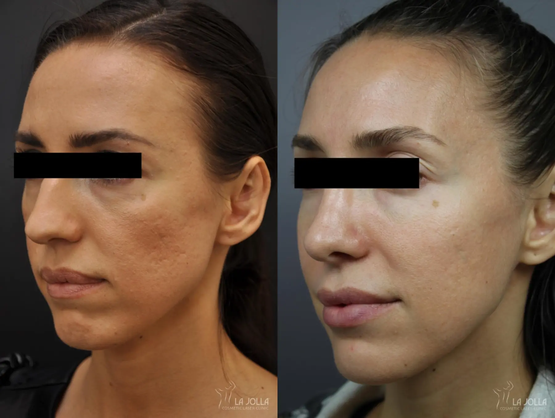 Sculptra®: Patient 22 - Before and After 1