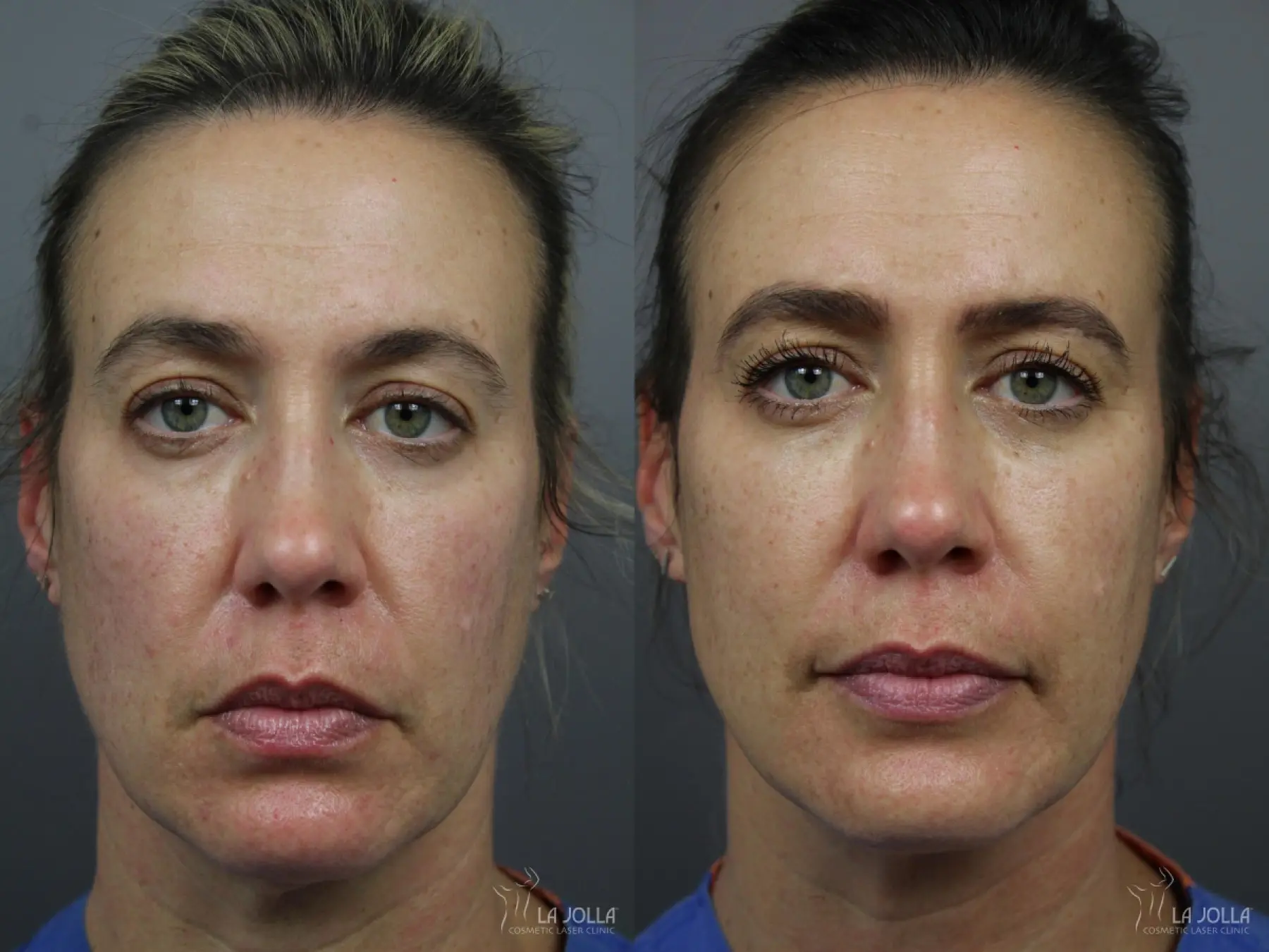 Sculptra®: Patient 16 - Before and After 1