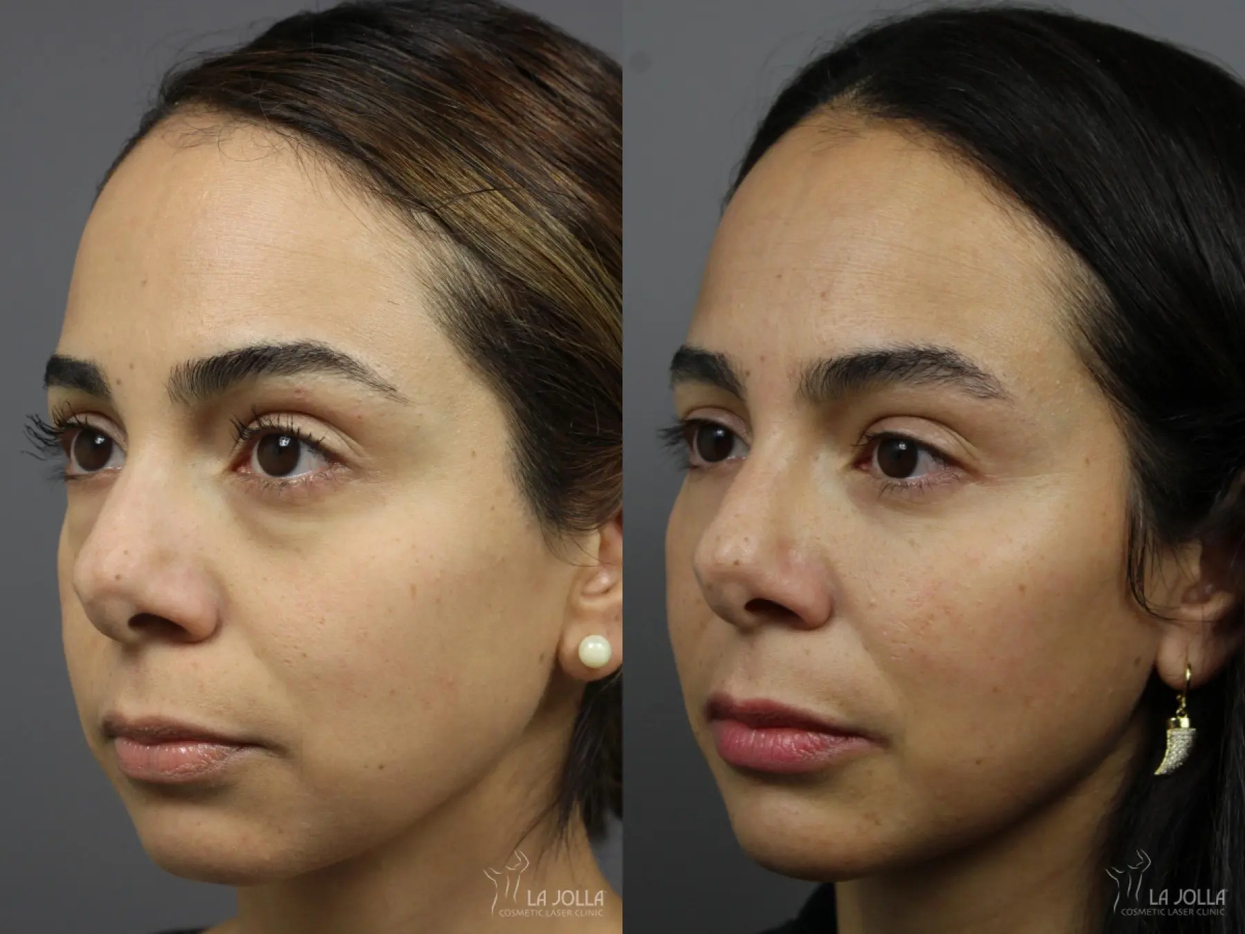 Sculptra®: Patient 11 - Before and After 2