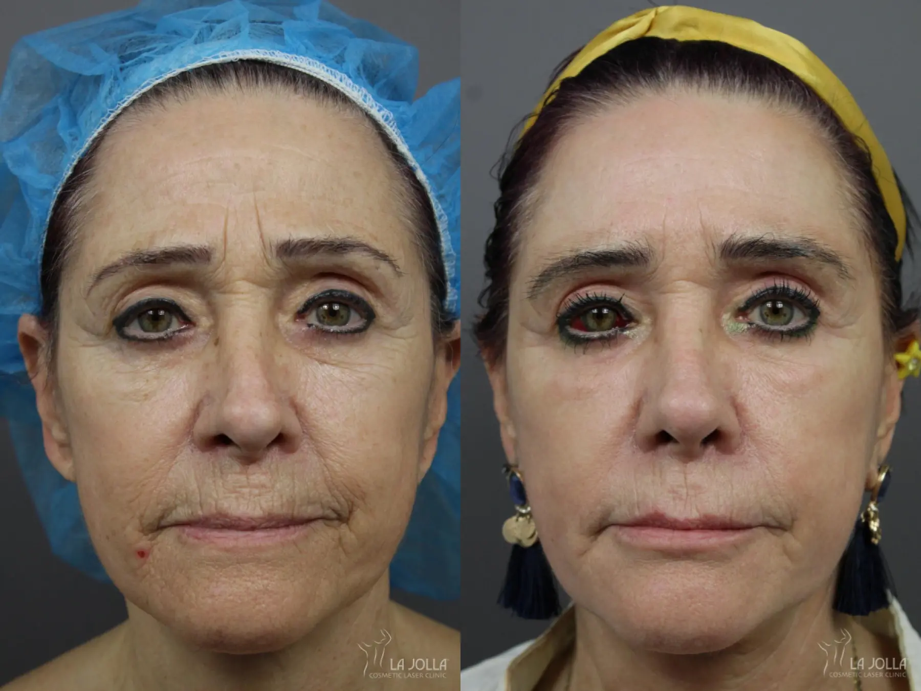 Sculptra®: Patient 9 - Before and After 1