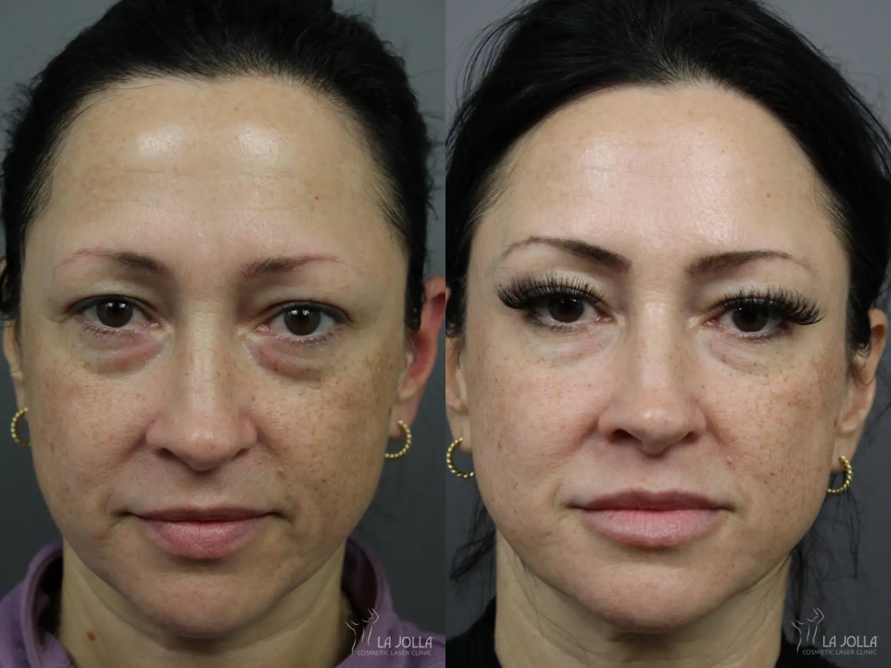 Sculptra®: Patient 6 - Before and After 2