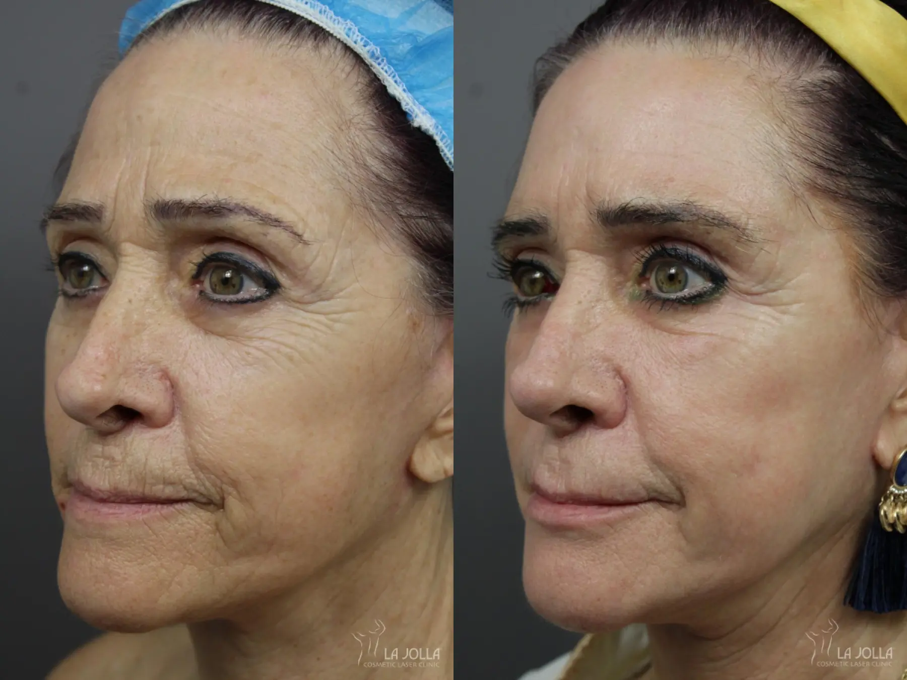 Sculptra®: Patient 9 - Before and After 2
