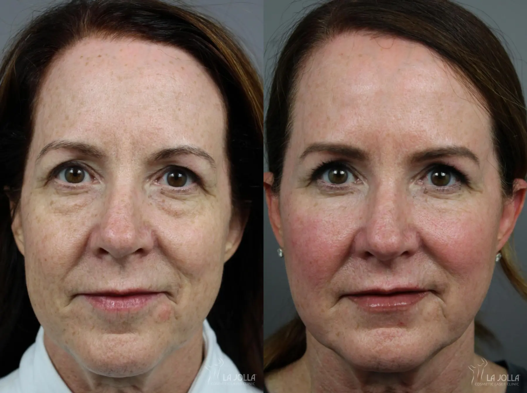 Sculptra®: Patient 4 - Before and After 1