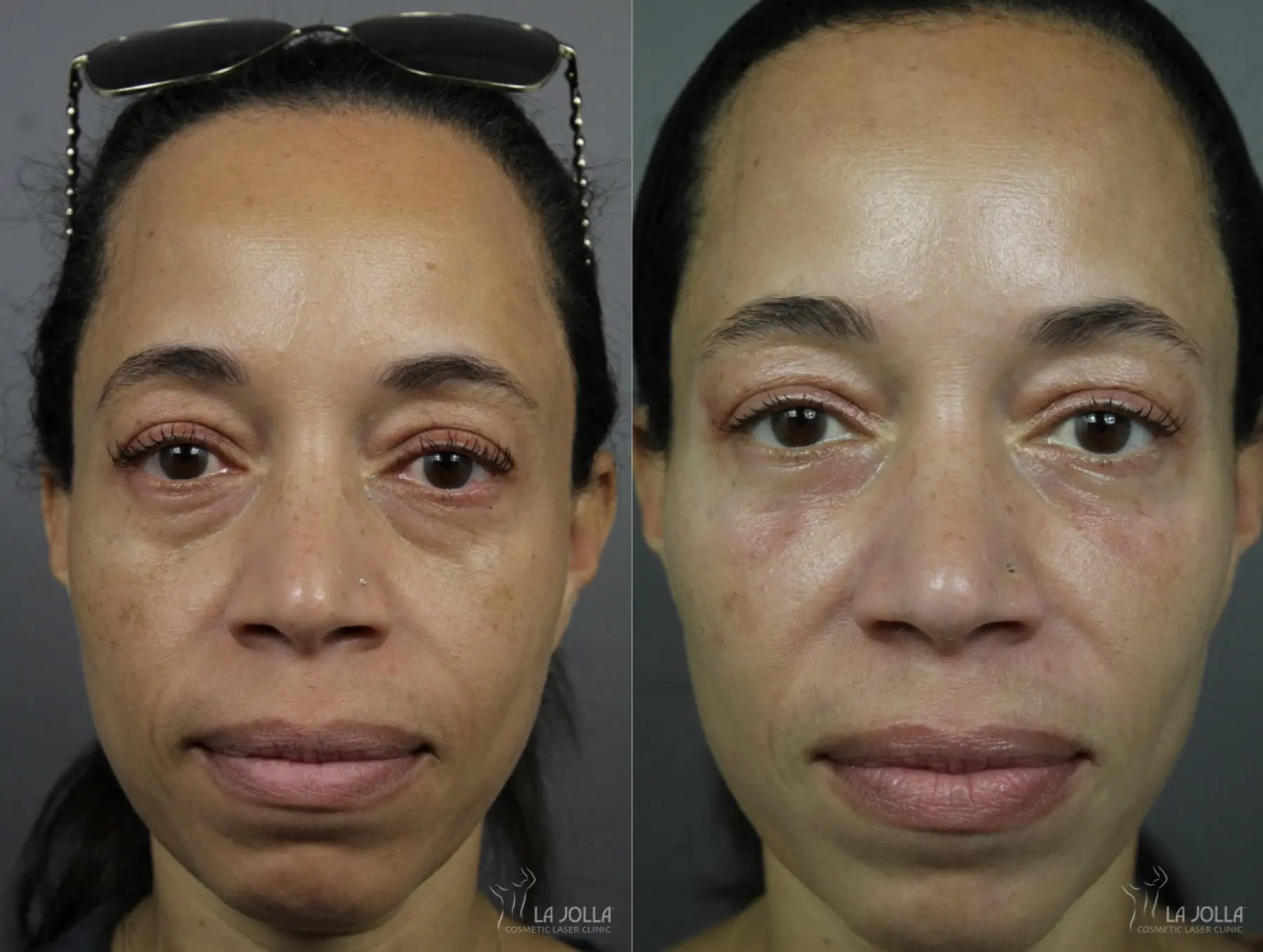 Sculptra® Before & After Gallery: Patient 2