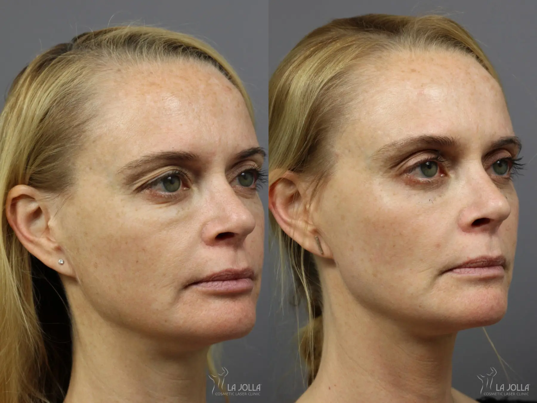 Sculptra®: Patient 12 - Before and After 1