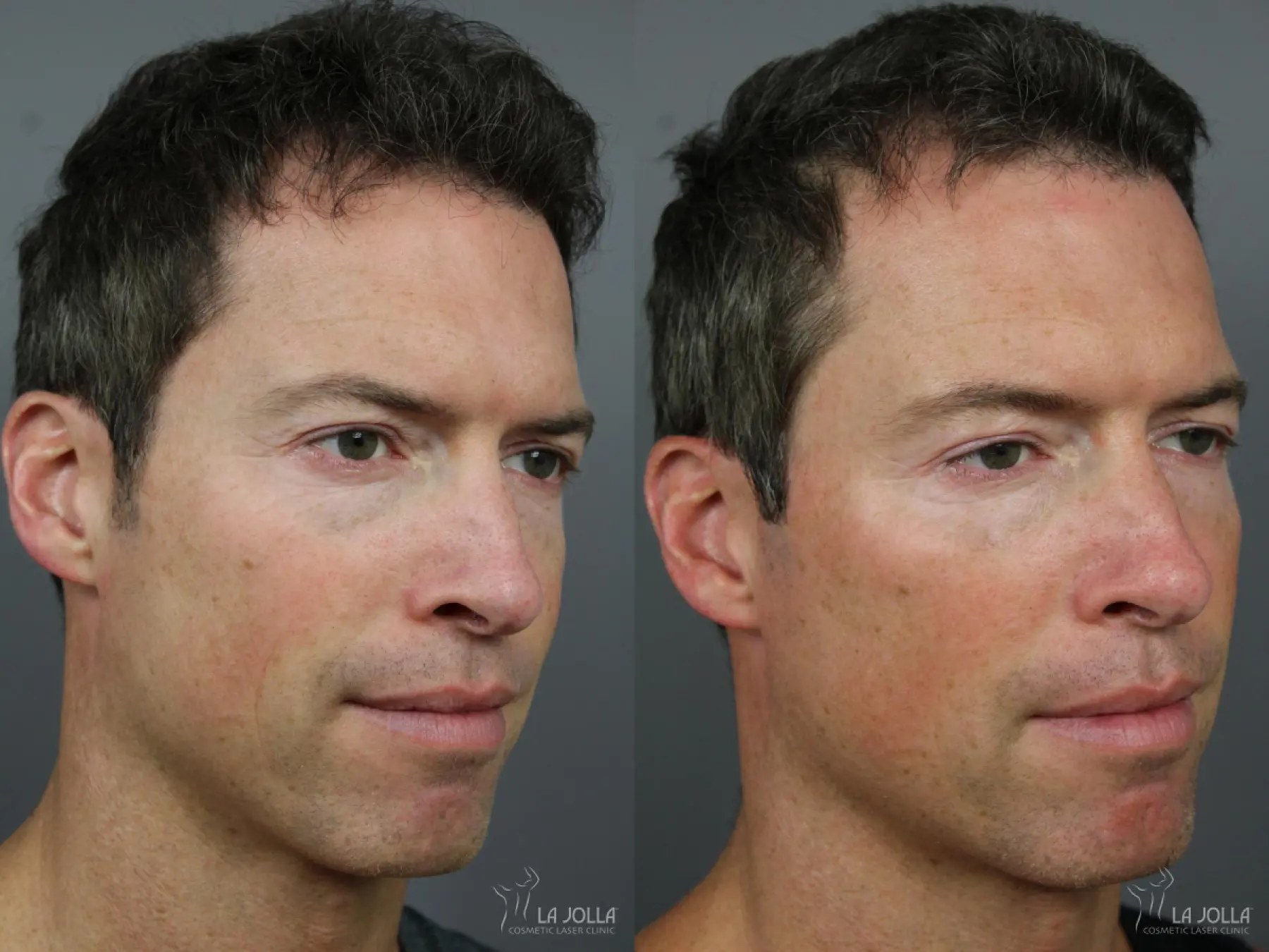 Sculptra®: Patient 14 - Before and After 1