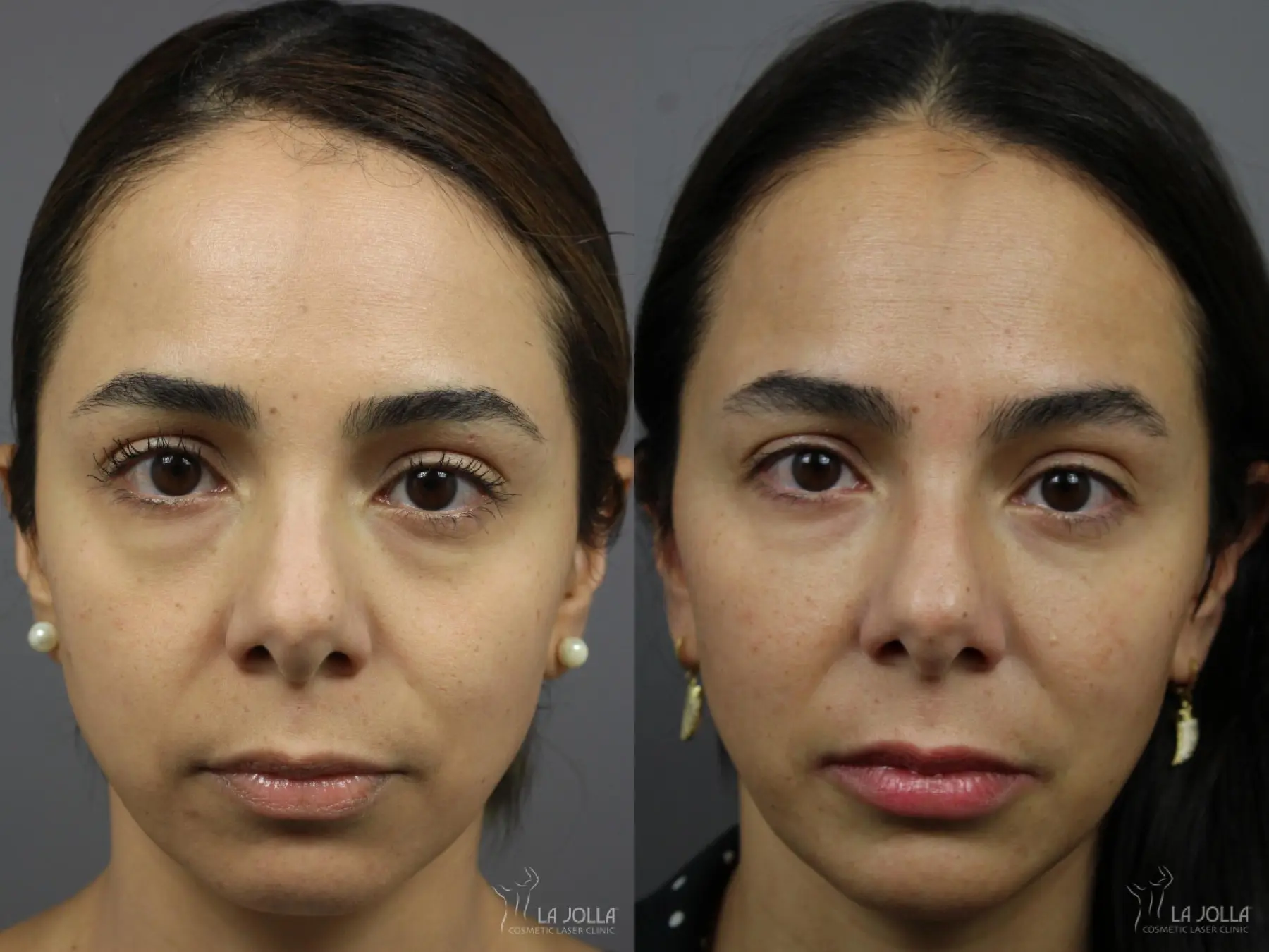 Sculptra®: Patient 11 - Before and After 1