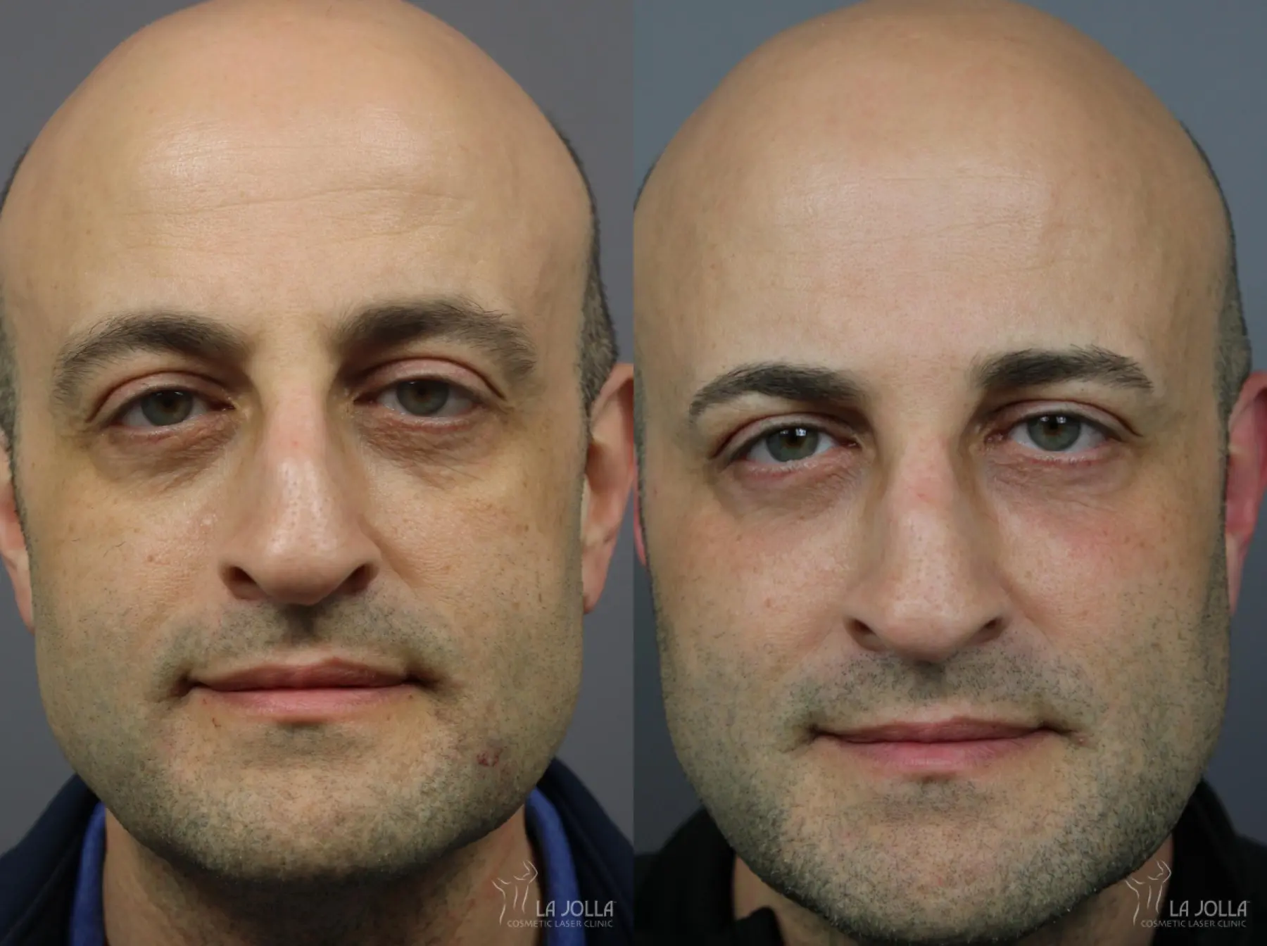 Sculptra®: Patient 3 - Before and After 1