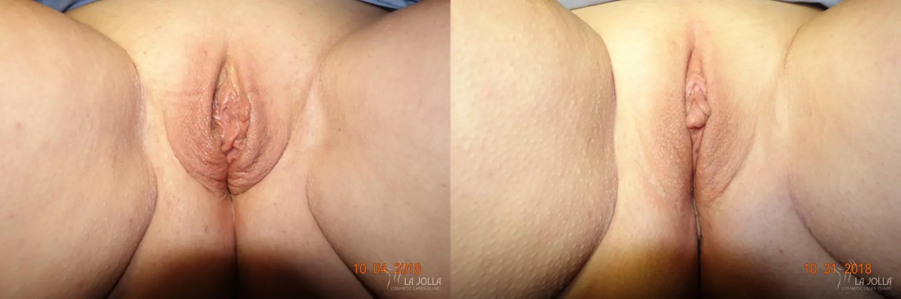 ThermiVa®: Patient 1 - Before and After  