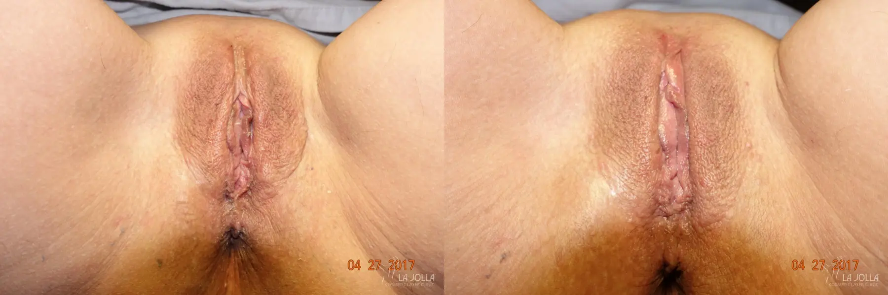ThermiVa®: Patient 7 - Before and After  